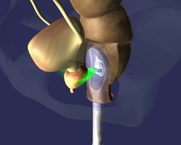 o impacto do ultra-som na próstata com prostatite