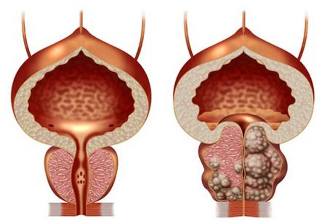 próstata saudável e adenoma de próstata
