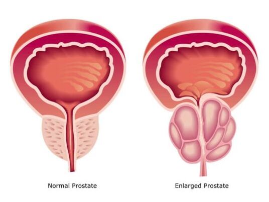 Próstata normal e aumentada