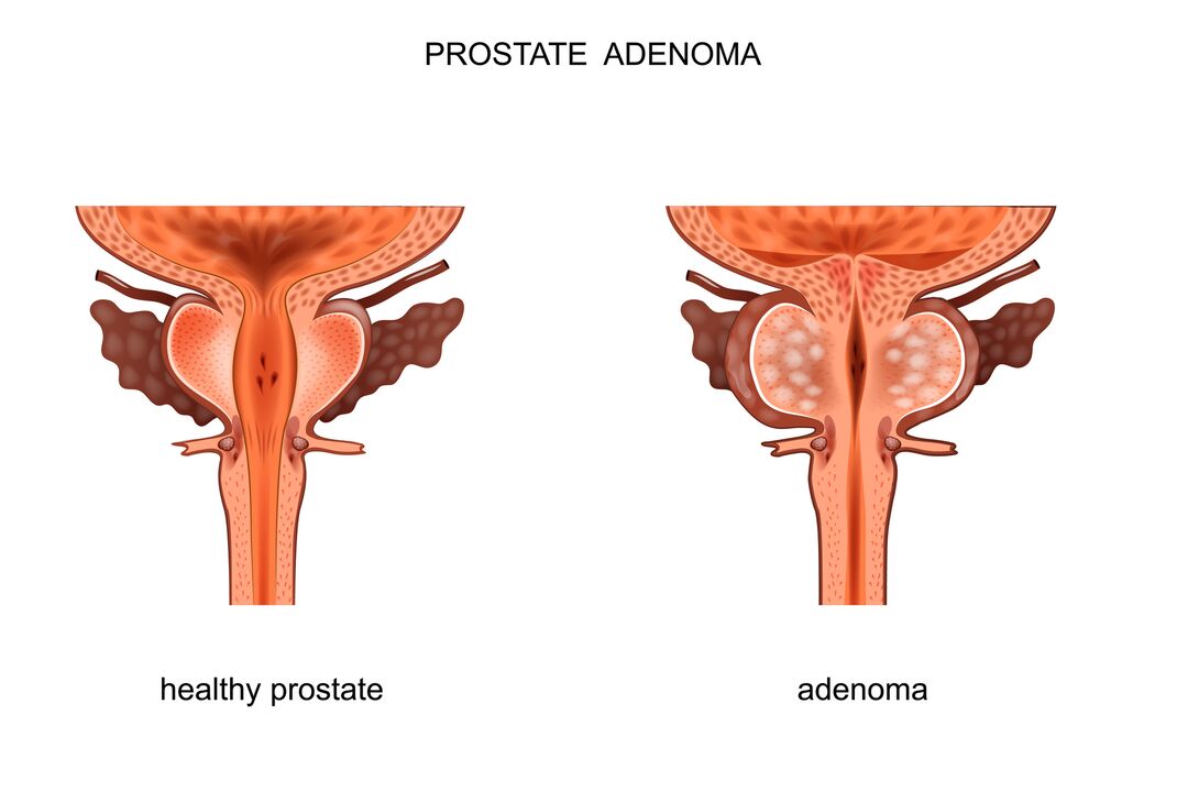próstata saudável e com adenoma
